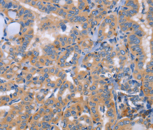 Immunohistochemistry of paraffin-embedded Human thyroid cancer using CD328 Polyclonal Antibody at dilution of 1:50
