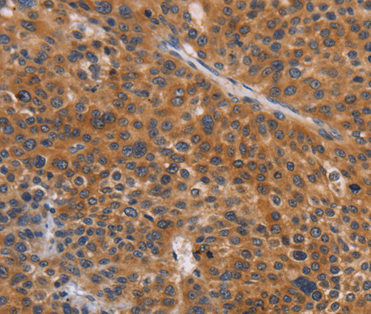 Immunohistochemistry of paraffin-embedded Human liver cancer tissue using NCR1 Polyclonal Antibody at dilution 1:30