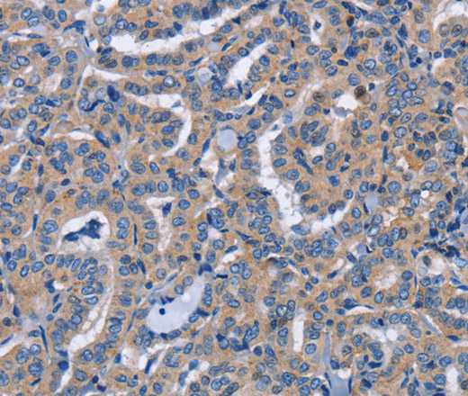 Immunohistochemistry of paraffin-embedded Human thyroid cancer tissue using NCR2 Polyclonal Antibody at dilution 1:60