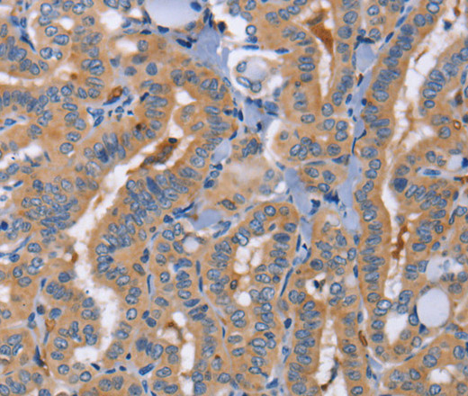 Immunohistochemistry of paraffin-embedded Human thyroid cancer using CD327 Polyclonal Antibody at dilution of 1:70