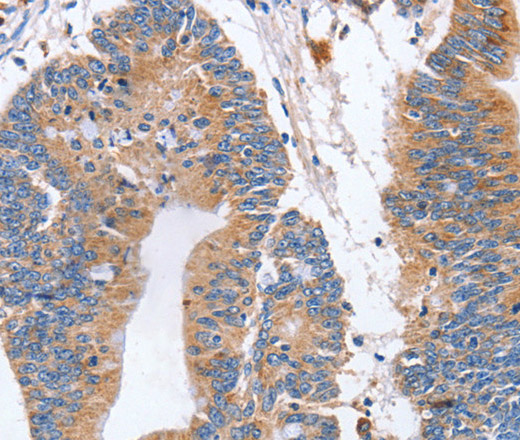 Immunohistochemistry of paraffin-embedded Human colon cancer using CD327 Polyclonal Antibody at dilution of 1:70