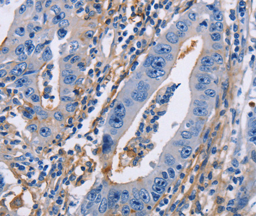 Immunohistochemistry of paraffin-embedded Human gastric cancer using CD54 Polyclonal Antibody at dilution of 1:30