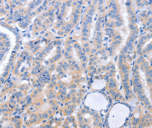 Immunohistochemistry of paraffin-embedded Human thyroid cancer using B3GAT1 Polyclonal Antibody at dilution of 1:40