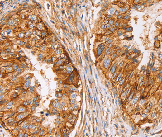 Immunohistochemistry of paraffin-embedded Human cervical cancer using CD59 Polyclonal Antibody at dilution of 1:50