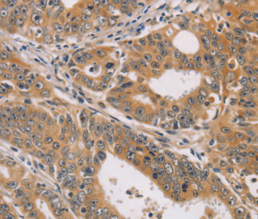 Immunohistochemistry of paraffin-embedded Human gastric cancer using CDK11B Polyclonal Antibody at dilution of 1:40