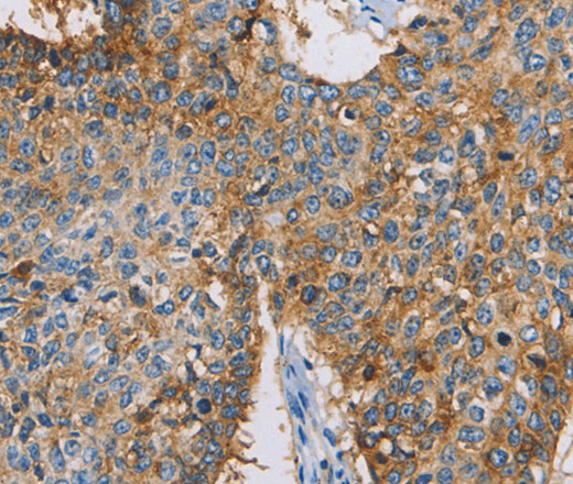 Immunohistochemistry of paraffin-embedded Human lung cancer using CDCP1 Polyclonal Antibody at dilution of 1:50