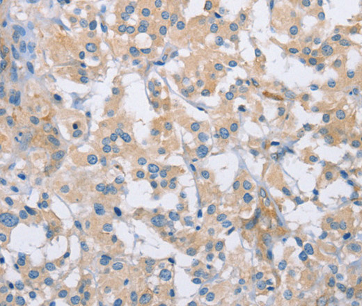 Immunohistochemistry of paraffin-embedded Human thyroid cancer using CDCP1 Polyclonal Antibody at dilution of 1:50