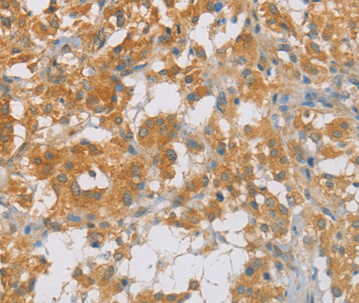 Immunohistochemistry of paraffin-embedded Human thyroid cancer tissue using p16 Polyclonal Antibody at dilution 1:60