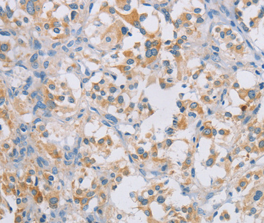 Immunohistochemistry of paraffin-embedded Human thyroid cancer tissue using CERKL Polyclonal Antibody at dilution 1:50