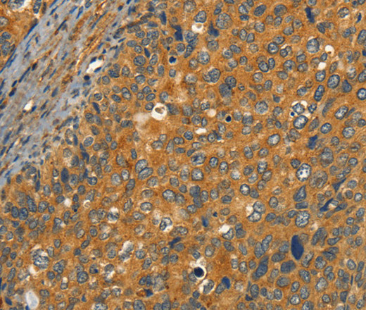 Immunohistochemistry of paraffin-embedded Human cervical cancer tissue using CIB1 Polyclonal Antibody at dilution 1:30