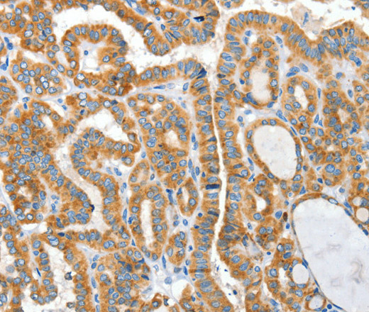 Immunohistochemistry of paraffin-embedded Human thyroid cancer using CKAP4 Polyclonal Antibody at dilution of 1:50