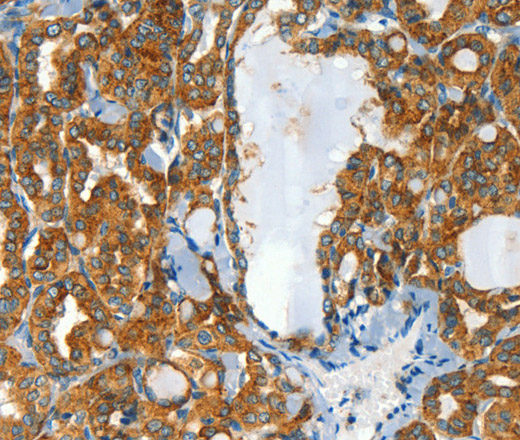 Immunohistochemistry of paraffin-embedded Human thyroid cancer tissue using CLPTM1L Polyclonal Antibody at dilution 1:60