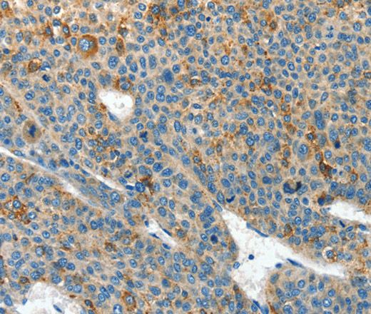 Immunohistochemistry of paraffin-embedded Human liver cancer tissue using CLPTM1L Polyclonal Antibody at dilution 1:60