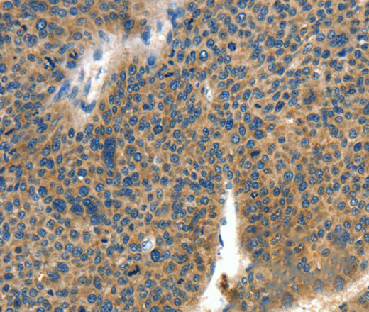 Immunohistochemistry of paraffin-embedded Human liver cancer tissue using COL4A2 Polyclonal Antibody at dilution 1:70