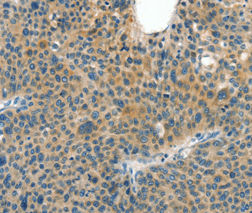 Immunohistochemistry of paraffin-embedded Human liver cancer tissue using CRLF2 Polyclonal Antibody at dilution 1:60