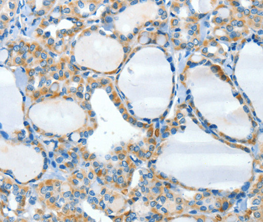 Immunohistochemistry of paraffin-embedded Human thyroid cancer tissue using HID1 Polyclonal Antibody at dilution 1:50