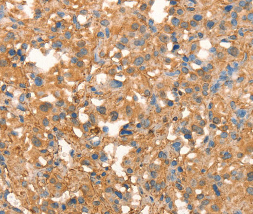 Immunohistochemistry of paraffin-embedded Human thyroid cancer using CRELD1 Polyclonal Antibody at dilution of 1:40