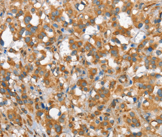 Immunohistochemistry of paraffin-embedded Human thyroid cancer tissue using CSMD1 Polyclonal Antibody at dilution 1:40