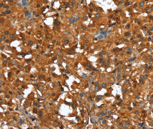 Immunohistochemistry of paraffin-embedded Human thyroid cancer using CTBP1 Polyclonal Antibody at dilution of 1:40