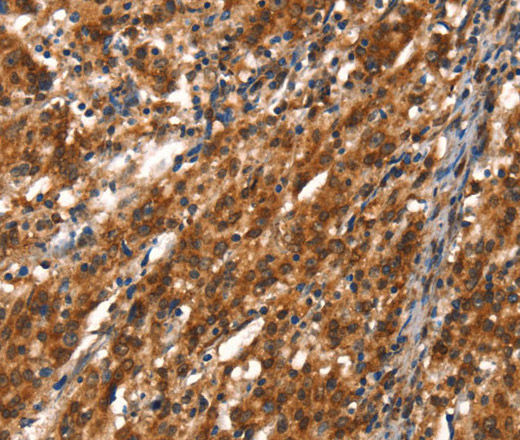 Immunohistochemistry of paraffin-embedded Human gasrtic cancer tissue using CYP2D6 Polyclonal Antibody at dilution 1:40