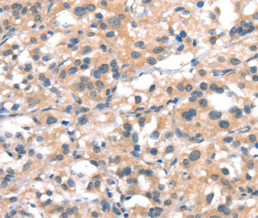 Immunohistochemistry of paraffin-embedded Human thyroid cancer tissue using CYP2D6 Polyclonal Antibody at dilution 1:40