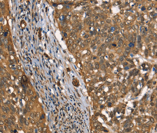 Immunohistochemistry of paraffin-embedded Human cervical cancer tissue using CSTB Polyclonal Antibody at dilution 1:30