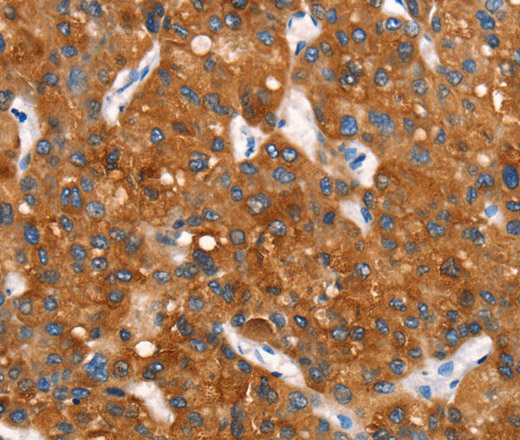 Immunohistochemistry of paraffin-embedded Human liver cancer tissue using Cytochrome b Polyclonal Antibody at dilution 1:30