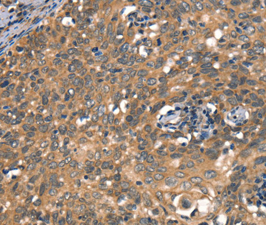 Immunohistochemistry of paraffin-embedded Human cervical cancer using DAAM1 Polyclonal Antibody at dilution of 1:50