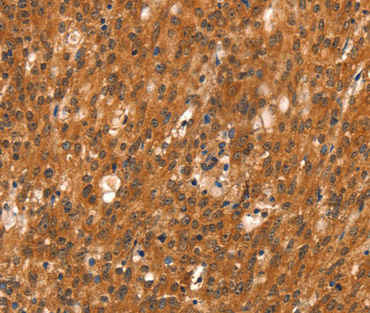 Immunohistochemistry of paraffin-embedded Human gasrtic cancer tissue using DAB2IP Polyclonal Antibody at dilution 1:40