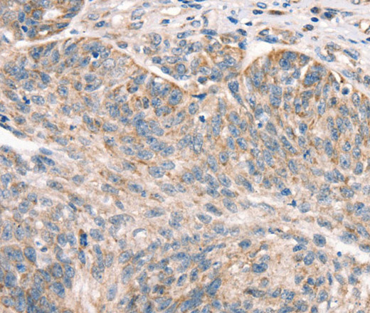 Immunohistochemistry of paraffin-embedded Human ovarian cancer using DECR1 Polyclonal Antibody at dilution of 1:50