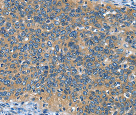 Immunohistochemistry of paraffin-embedded Human cervical cancer tissue using DTX1 Polyclonal Antibody at dilution 1:30