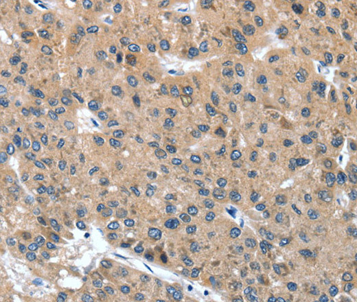 Immunohistochemistry of paraffin-embedded Human liver cancer tissue using DSC1 Polyclonal Antibody at dilution 1:40