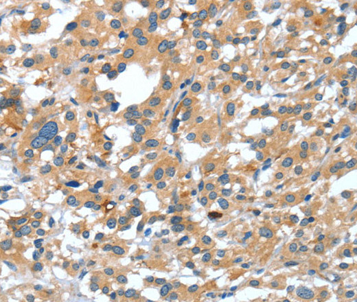 Immunohistochemistry of paraffin-embedded Human thyroid cancer tissue using DSC1 Polyclonal Antibody at dilution 1:40