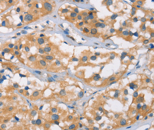 Immunohistochemistry of paraffin-embedded Human thyroid cancer tissue using DSC2 Polyclonal Antibody at dilution 1:35