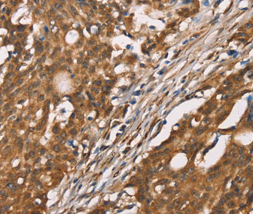 Immunohistochemistry of paraffin-embedded Human gasrtic cancer tissue using DICER1 Polyclonal Antibody at dilution 1:40