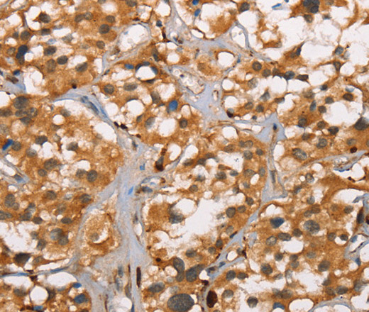 Immunohistochemistry of paraffin-embedded Human thyroid cancer tissue using DICER1 Polyclonal Antibody at dilution 1:40