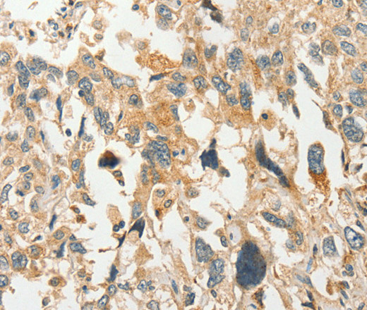 Immunohistochemistry of paraffin-embedded Human esophagus cancer tissue using SLC11A2 Polyclonal Antibody at dilution 1:50