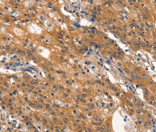 Immunohistochemistry of paraffin-embedded Human gastic cancer using DNM2 Polyclonal Antibody at dilution of 1:40