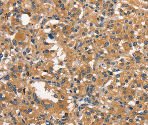 Immunohistochemistry of paraffin-embedded Human thyroid cancer using DNM2 Polyclonal Antibody at dilution of 1:40