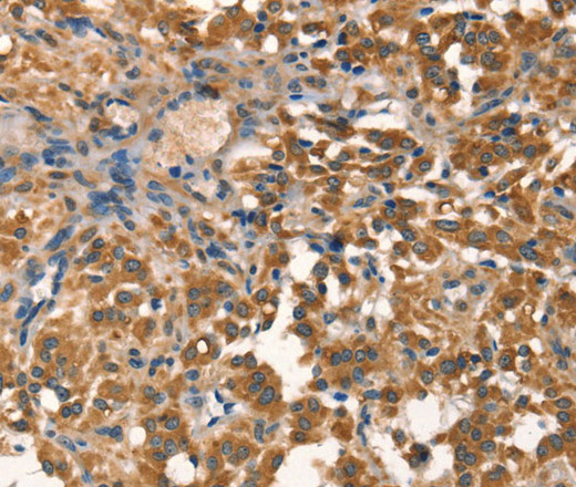 Immunohistochemistry of paraffin-embedded Human thyroid cancer tissue using AGO1 Polyclonal Antibody at dilution 1:40