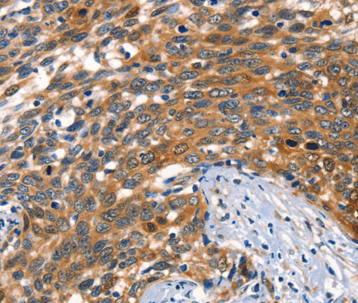 Immunohistochemistry of paraffin-embedded Human cervical cancer tissue using AGO1 Polyclonal Antibody at dilution 1:40