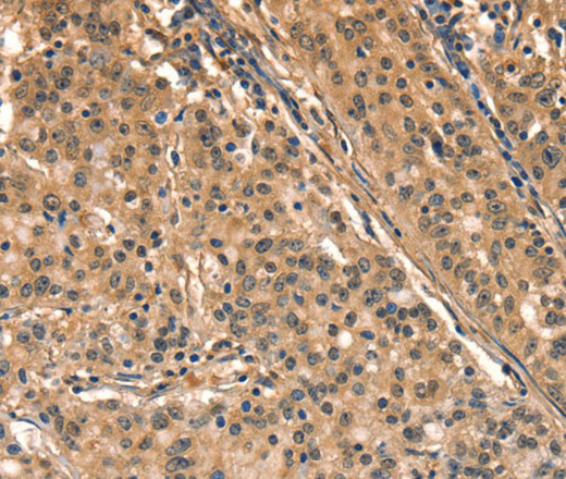 Immunohistochemistry of paraffin-embedded Human gastic cancer using AIMP1 Polyclonal Antibody at dilution of 1:40