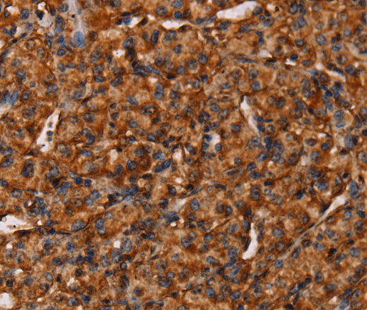 Immunohistochemistry of paraffin-embedded Human prostate cancer tissue using COL18A1 Polyclonal Antibody at dilution 1:40