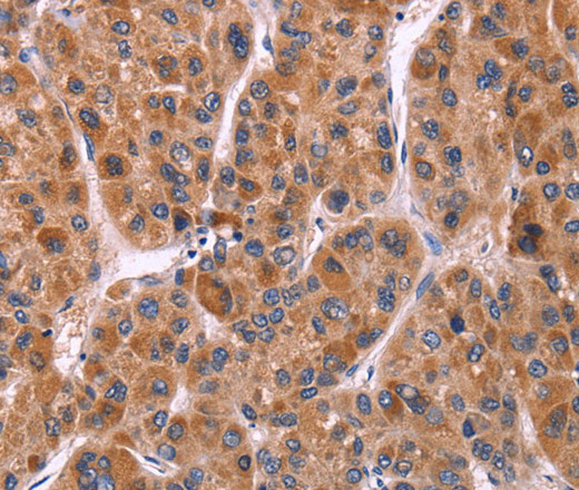 Immunohistochemistry of paraffin-embedded Human liver cancer tissue using Ephrin A5 Polyclonal Antibody at dilution 1:40