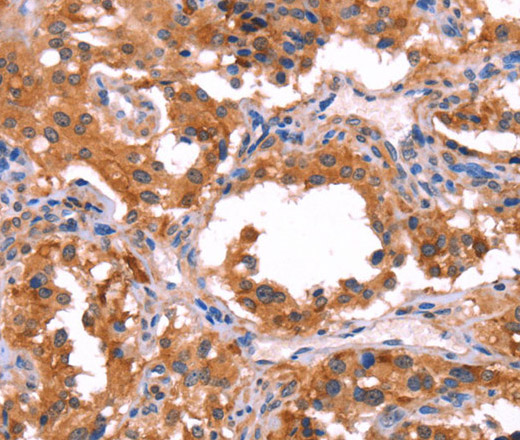 Immunohistochemistry of paraffin-embedded Human thyroid cancer using ERAS Polyclonal Antibody at dilution of 1:40