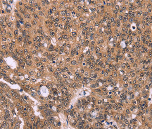 Immunohistochemistry of paraffin-embedded Human ovarian cancer using ERAS Polyclonal Antibody at dilution of 1:40