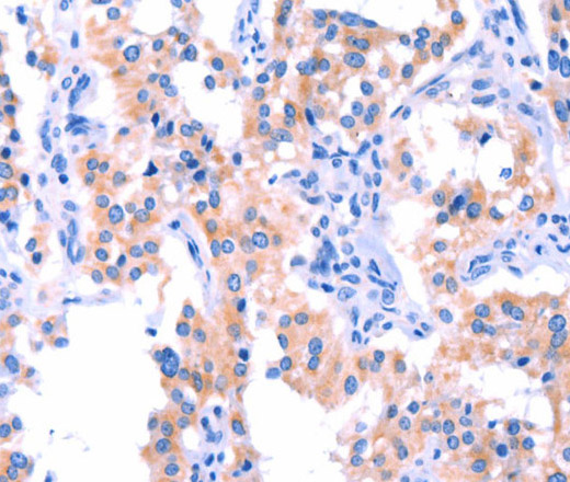 Immunohistochemistry of paraffin-embedded Human thyroid cancer tissue using ERN2 Polyclonal Antibody at dilution 1:40