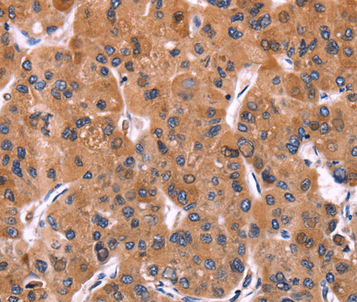 Immunohistochemistry of paraffin-embedded Human liver cancer using ERP29 Polyclonal Antibody at dilution of 1:40