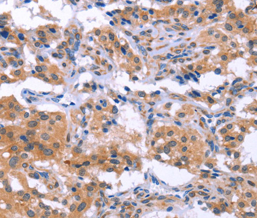 Immunohistochemistry of paraffin-embedded Human thyroid cancer using ESPL1 Polyclonal Antibody at dilution of 1:40