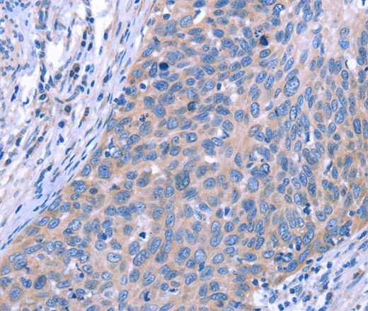 Immunohistochemistry of paraffin-embedded Human cervical cancer using ESPL1 Polyclonal Antibody at dilution of 1:40